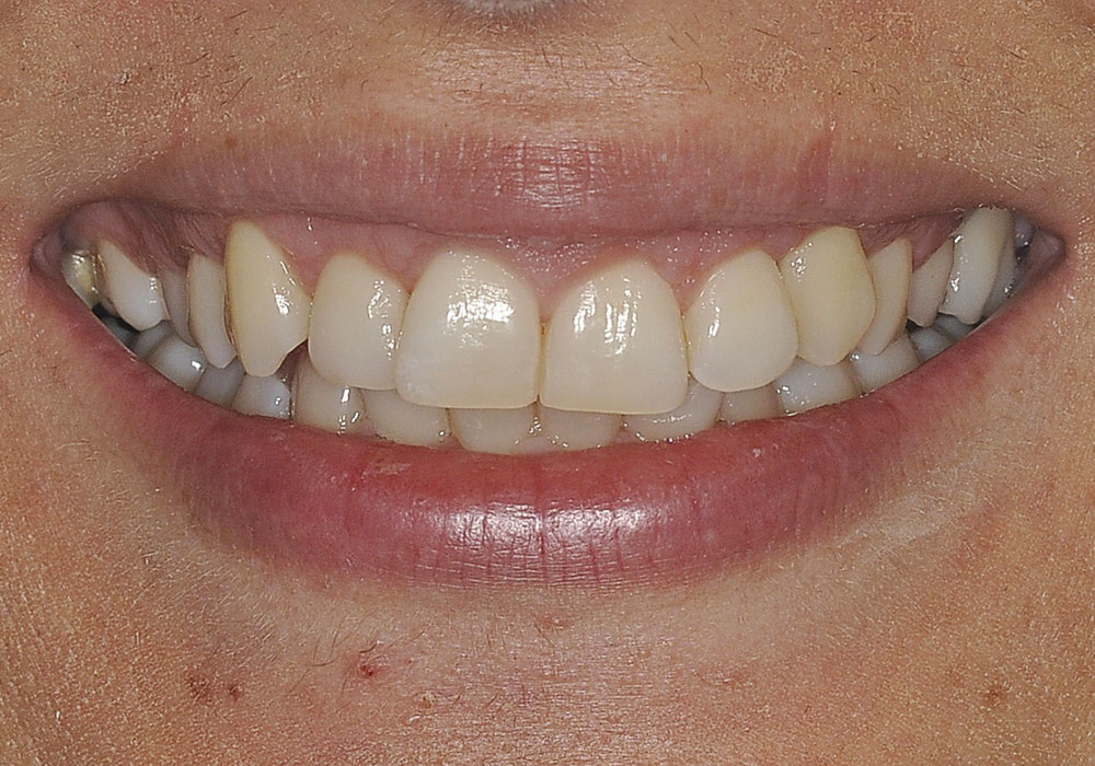 estetica-dentale-dopo